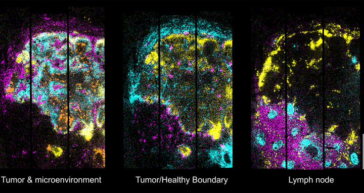 2D map of gene expression in the metastatic lymph node