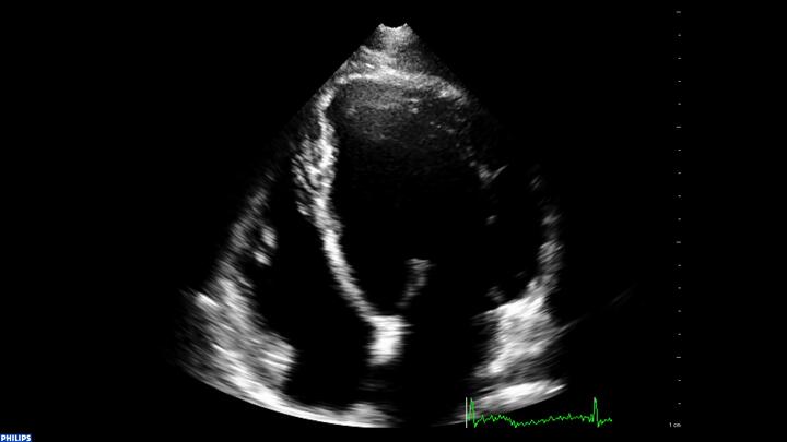 Ultraschallbild eines kranken Herzens