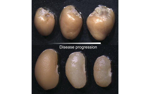 CRS_disease progression