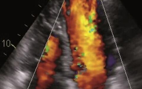 Color doppler echocardiography of a patient with Ebstein anomaly and LVNC