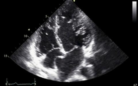 LVNC, Echocardiography in Diastole