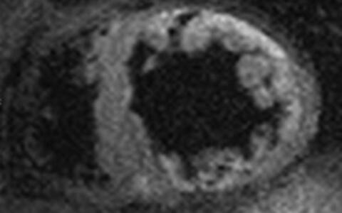 Fig. 1. Cardiac MRI of a Patient with LVNC