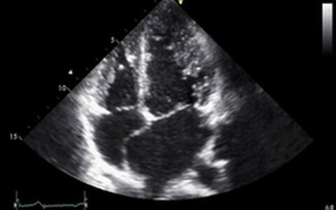 Fig 2. LVNC, Echocardiography in Systole