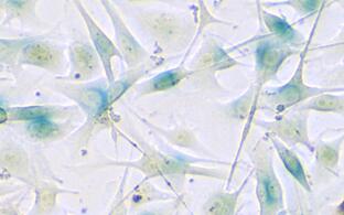Melanoma cells under the microscope