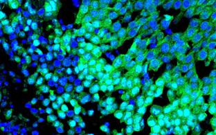 Immunofluorescence image of a basal breast tumour