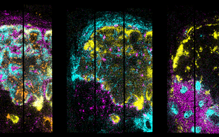 2D map of gene expression in the metastatic lymph node
